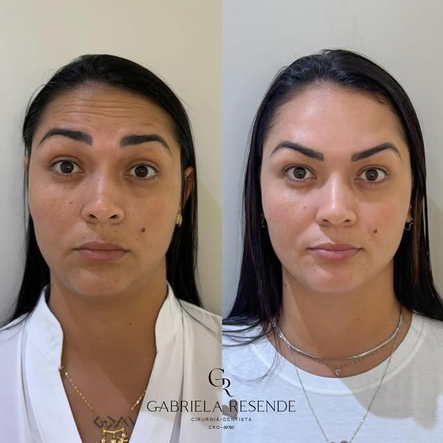 Antes e depois de procedimento facial